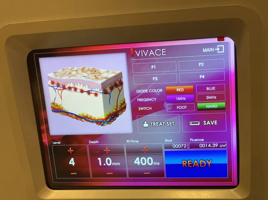 Wow Fresh Vivace: что это за процедура для лица и кому нужна