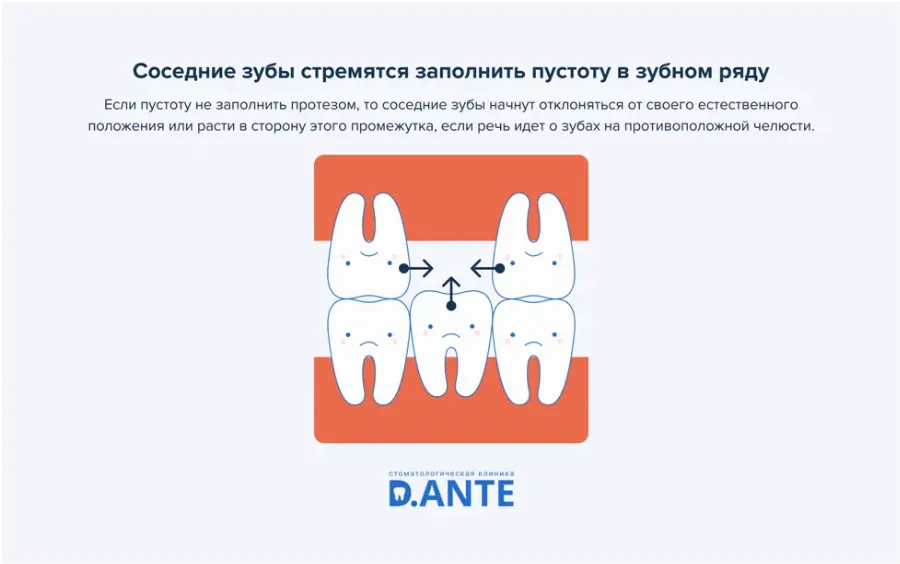 Вставні зуби