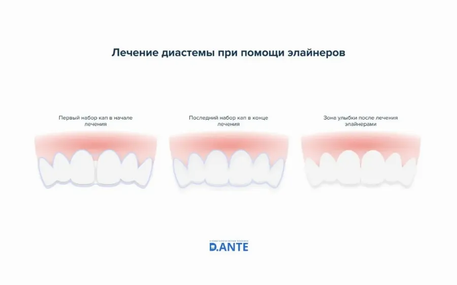 Лечение диастемы при помощи элайнеров