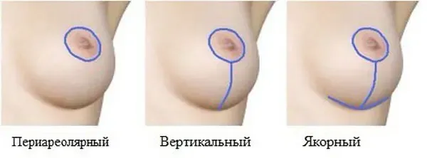подтяжка груди