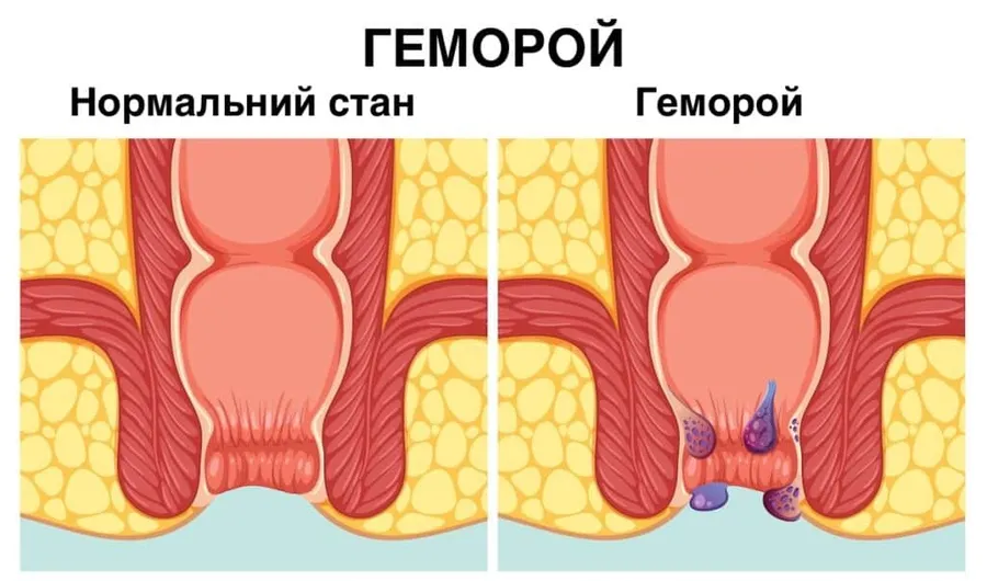 Що таке геморой?